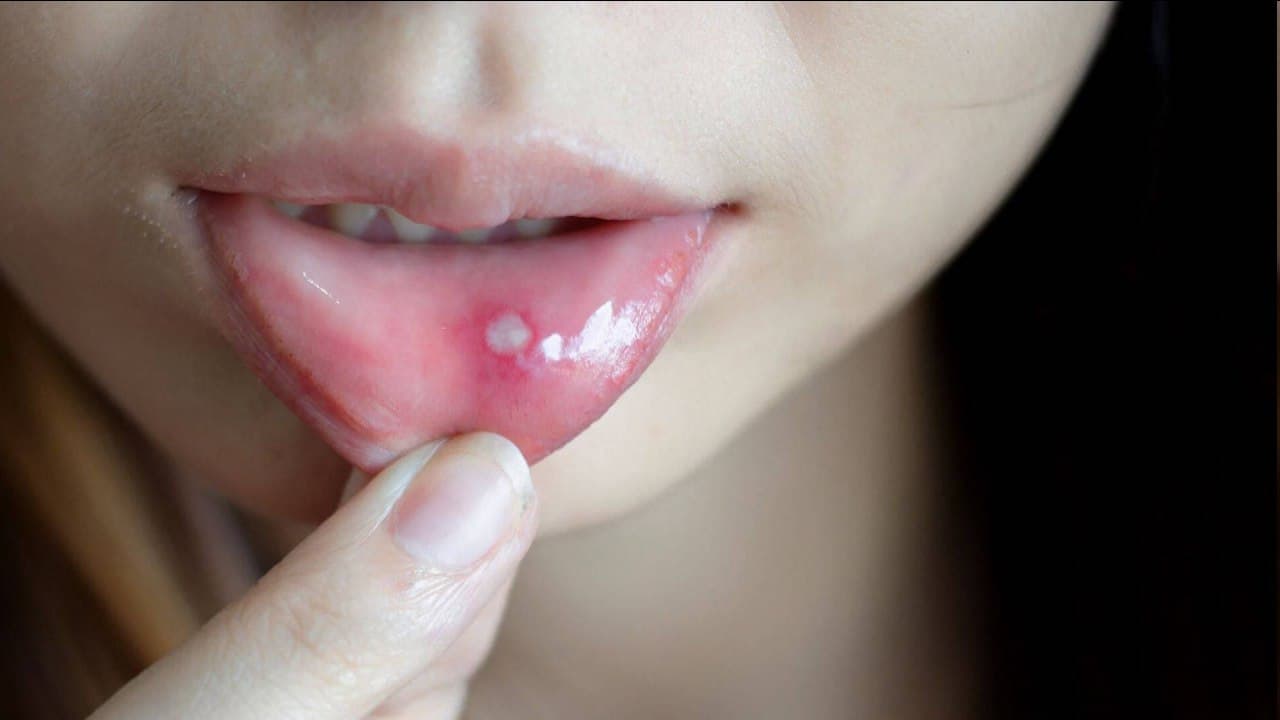 Стоматитдан қандай сақланиш керак?