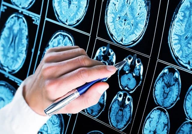 Tadqiqot: Epilepsiyani sun'iy intellekt yordamida aniqlash usuli yaratildi