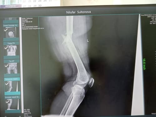 Shofirkon: suyak sinishi bilan bog‘liq murakkab jarrohlik amaliyoti muvaffaqiyatli bajarildi