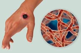 КУЙДИРГИ КАСАЛЛИГИ