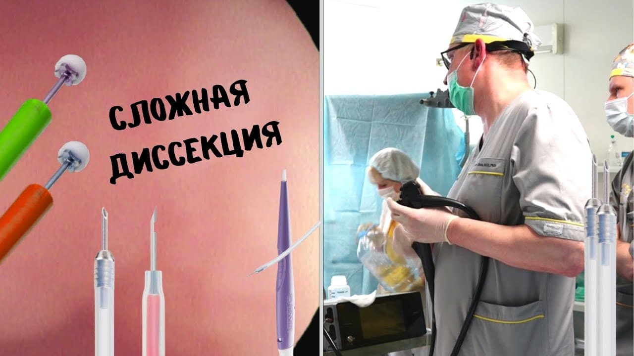 Buxoroda qiziloʻngach oʻsmasi disseksiyaga doir murakkab endoskopik amaliyot muvaffaqiyatli bajarildi