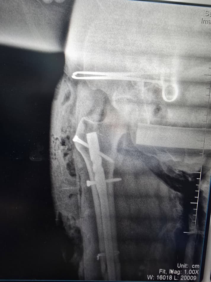 Шофиркон: суяк синиши билан боғлиқ мураккаб жарроҳлик амалиёти муваффақиятли бажарилди