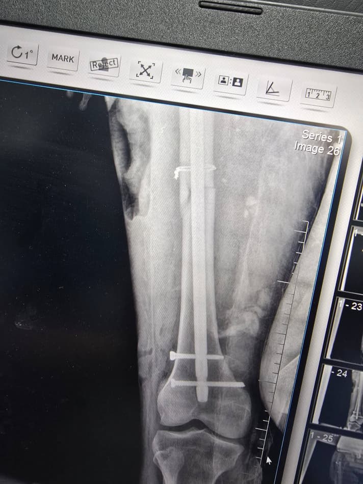 Шофиркон: суяк синиши билан боғлиқ мураккаб жарроҳлик амалиёти муваффақиятли бажарилди