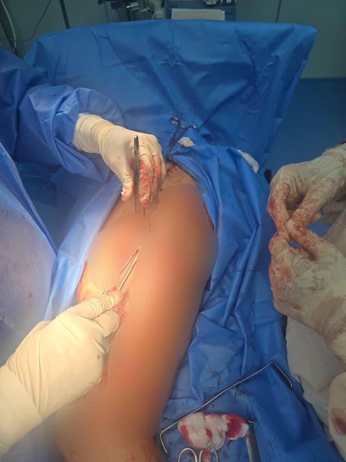 Шофиркон: суяк синиши билан боғлиқ мураккаб жарроҳлик амалиёти муваффақиятли бажарилди